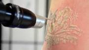 Tattoo Removal,  Skin Tags,  Skin Marks,  etc