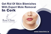 Get Rid Of Skin Blemishes With Expert Mole Removal In Cork