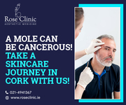 A mole can be cancerous! Take a skincare journey in Cork with us!